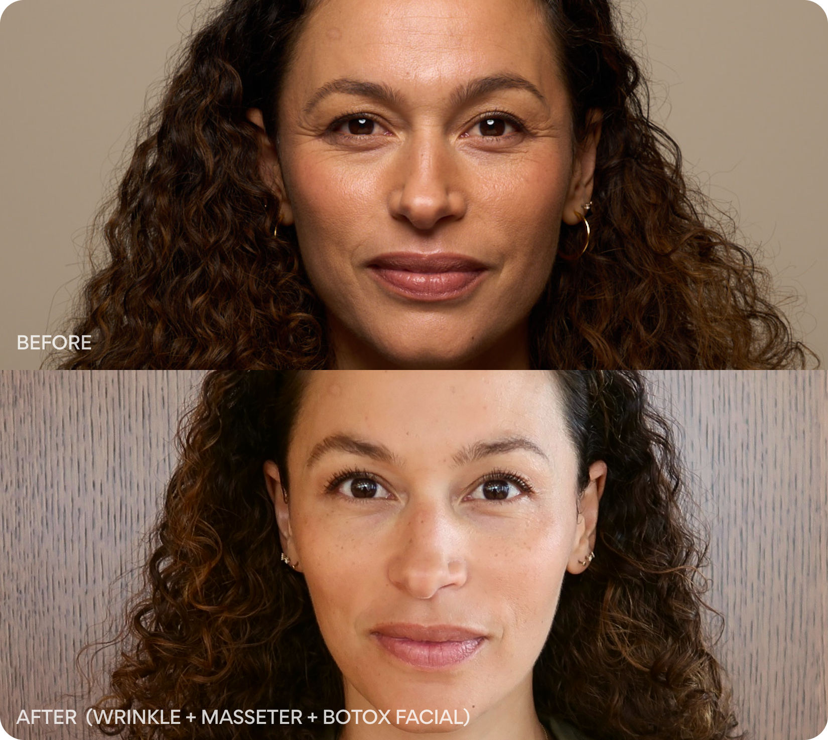 Before and after Wrinkle + Masseter + Botox facial