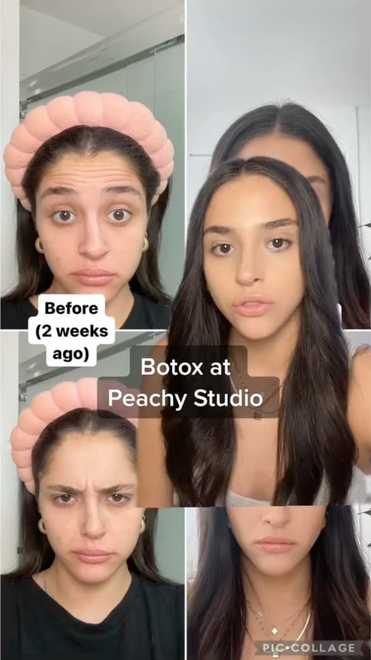 Botox at Peachy studio